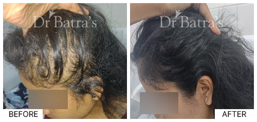 Hair Falling Treatment